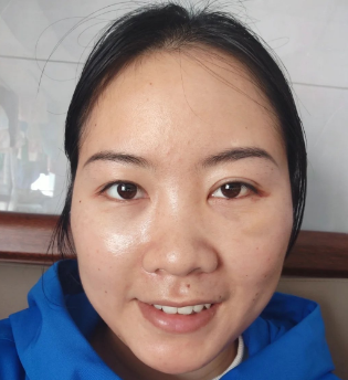 去眼袋手术