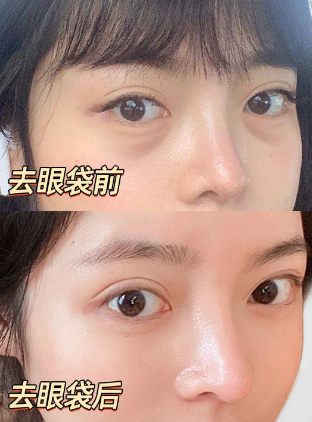 去眼袋手术
