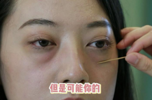 去眼袋手术