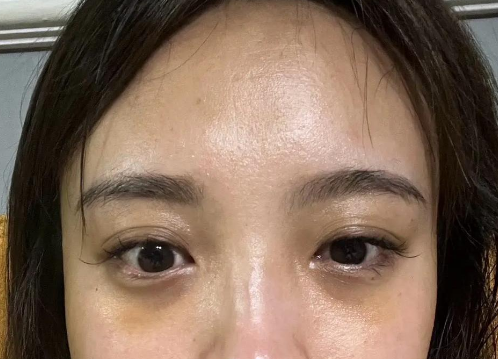 去眼袋手术