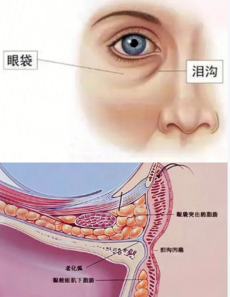 去眼袋手术