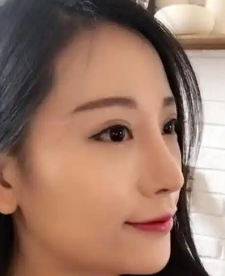 去眼袋手术
