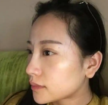 去眼袋手术