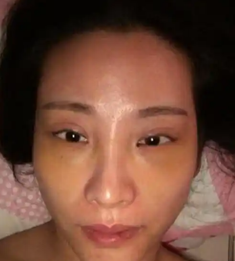 去眼袋手术