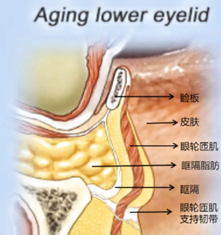 去眼袋手术