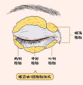 去眼袋手术