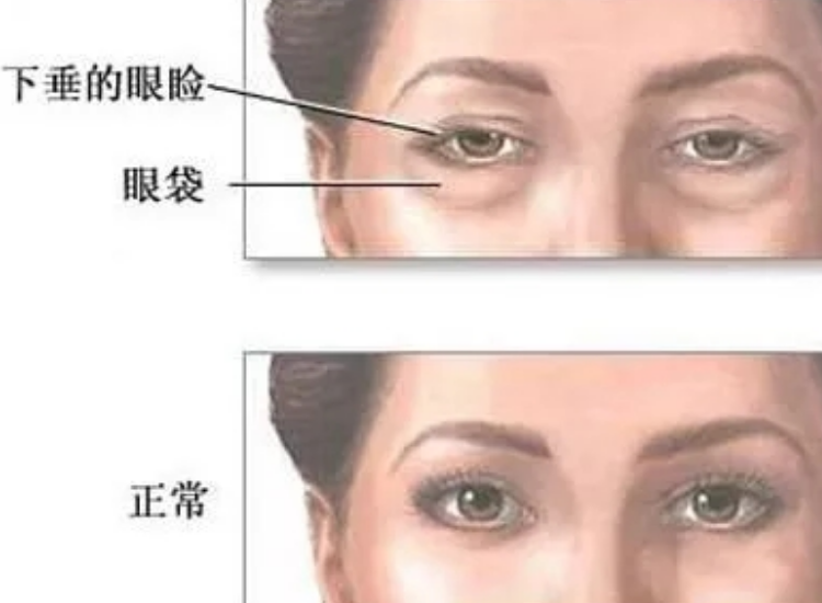去眼袋手术