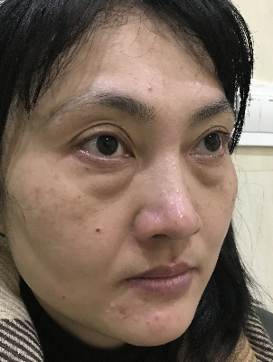 去眼袋手术