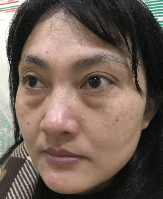 去眼袋手术