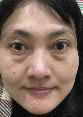 去眼袋手术