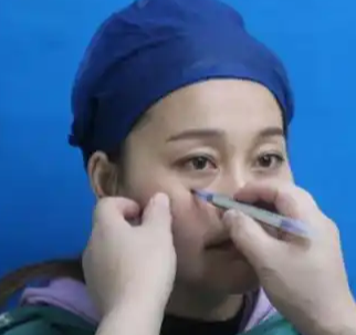 去眼袋手术