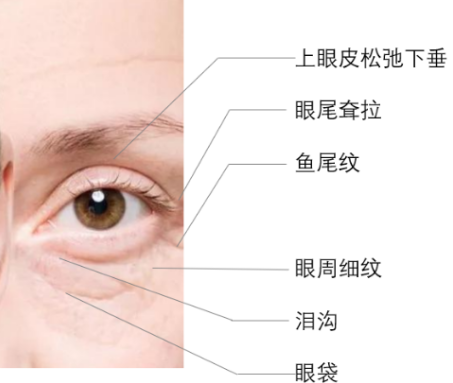 去眼袋手术