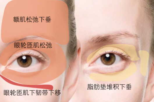 去眼袋手术