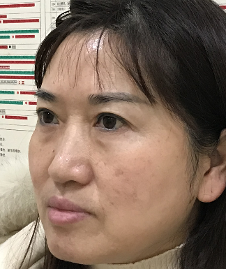 去眼袋手术