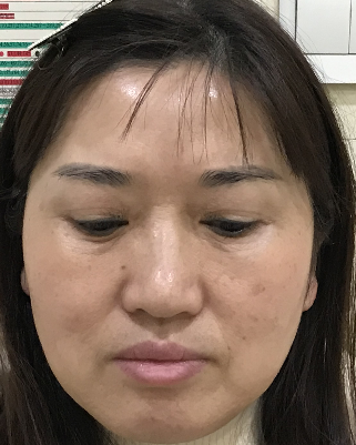 去眼袋手术