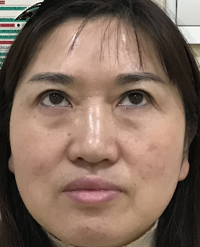 去眼袋手术