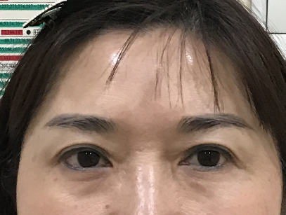 去眼袋手术