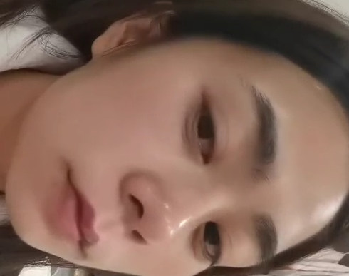 去眼袋手术