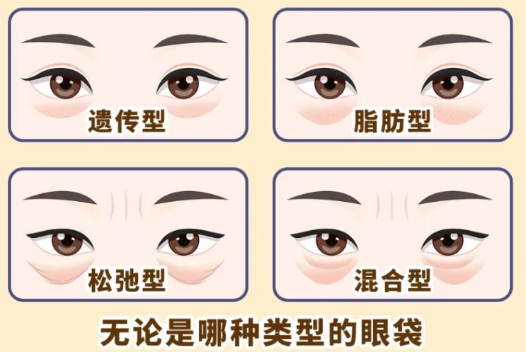 去眼袋手术
