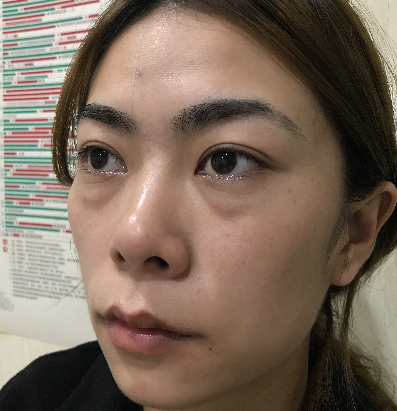 去眼袋手术