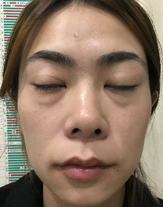 去眼袋手术