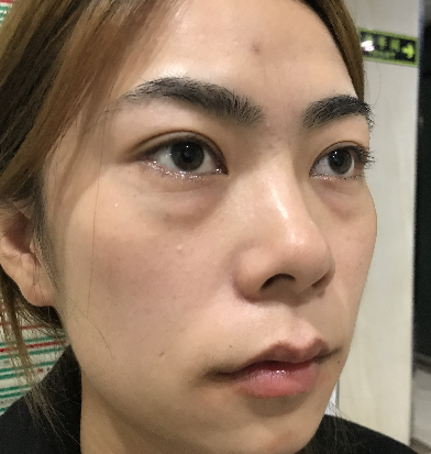 去眼袋手术