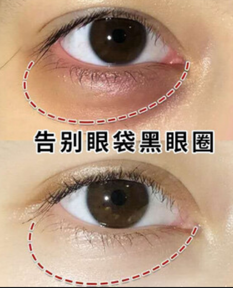 眼袋