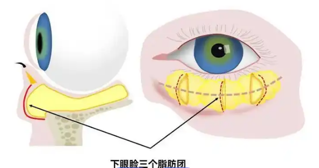 眼袋