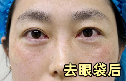 眼袋