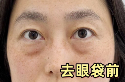 眼袋