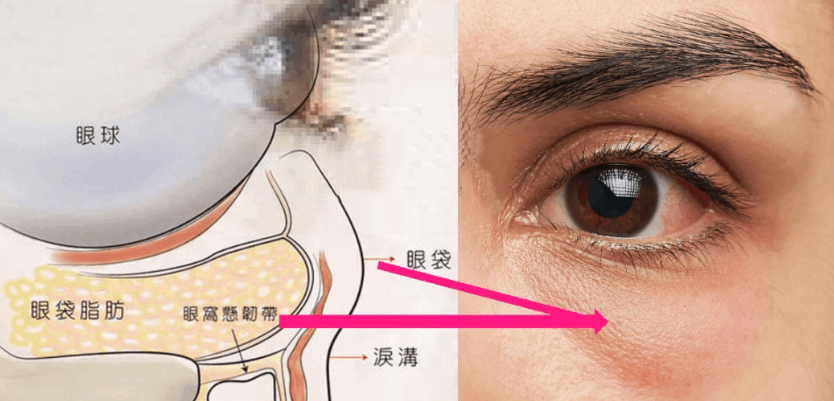 眼袋