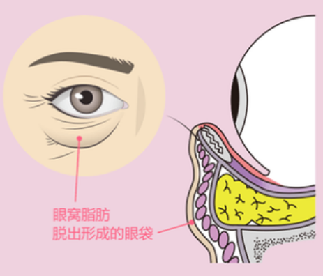眼袋