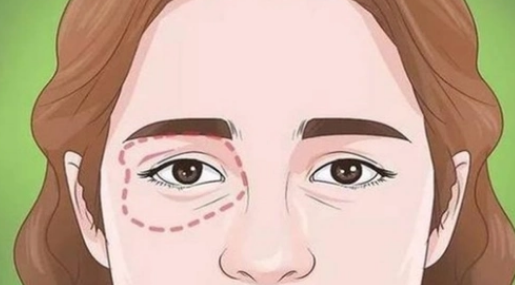 眼袋