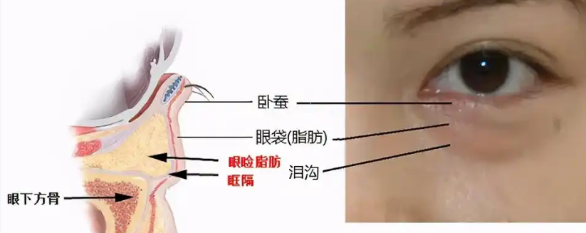 眼袋