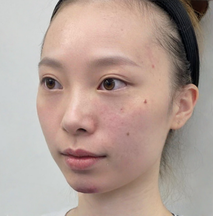 去眼袋手术