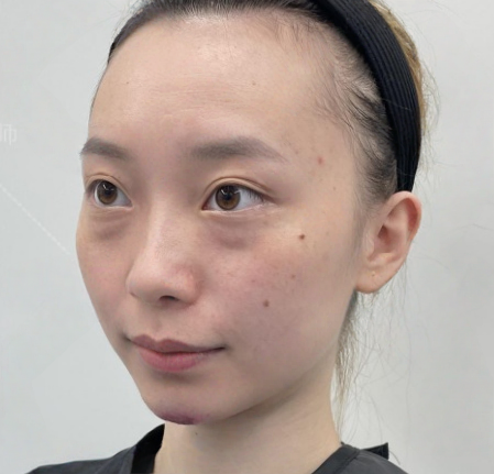 去眼袋手术