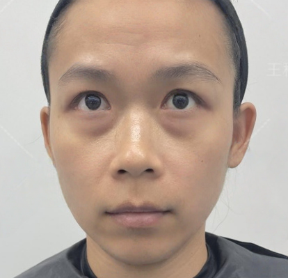 去眼袋手术
