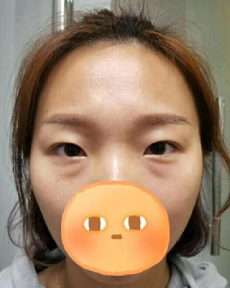 去眼袋手术