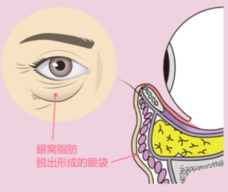 去眼袋手术
