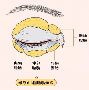 去眼袋手术