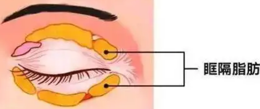 去眼袋手术