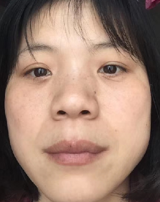 去眼袋手术