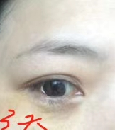 去眼袋手术
