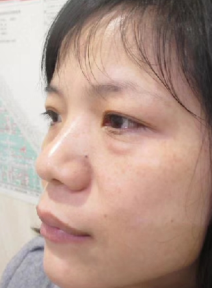 去眼袋手术