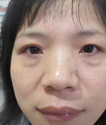 去眼袋手术