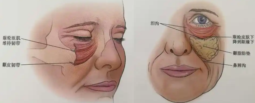去眼袋手术