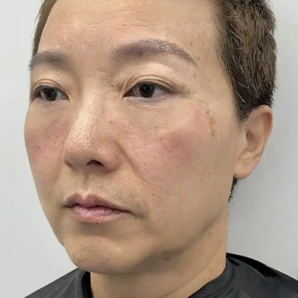 去眼袋手术