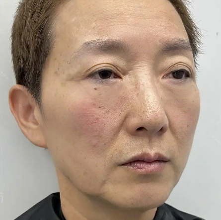 去眼袋手术