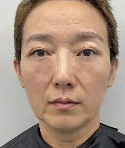 去眼袋手术