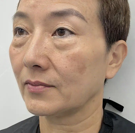 去眼袋手术